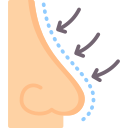 Rhinoplasty